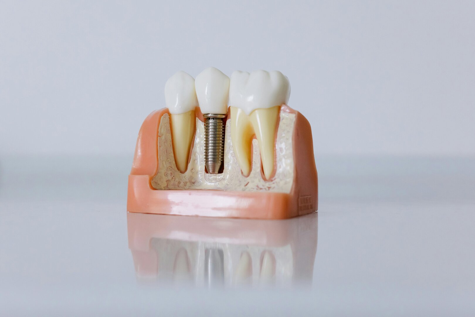 <h2 style="color:#0b3661;">Soluciones para reemplazar piezas dentales y mejorar tu mordida</h2>
